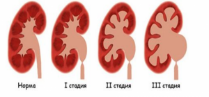 Пиелоэктазия у детей. Основные причины заболевания