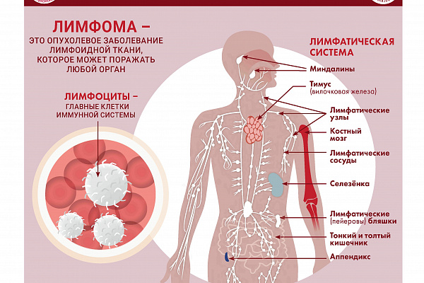 Специалистами ФГБУ «НМИЦ гематологии» Минздрава России разработана серия инфографики, где в простой и доступной форме представлена информация о заболеваниях системы крови